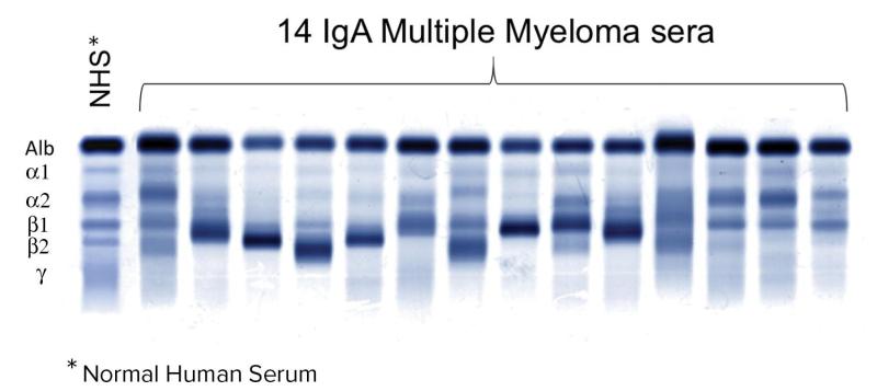 Use Hevylite when monoclonal proteins co-migrate on SPE