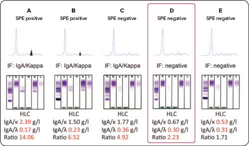 Using Hevylite for monitoring