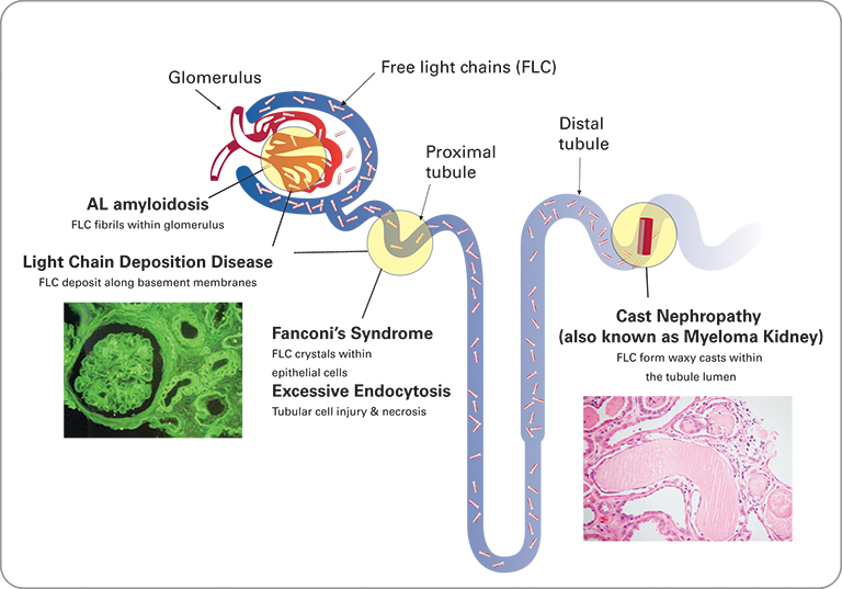 Overview of the Kidney and Plasma Cell Disorders